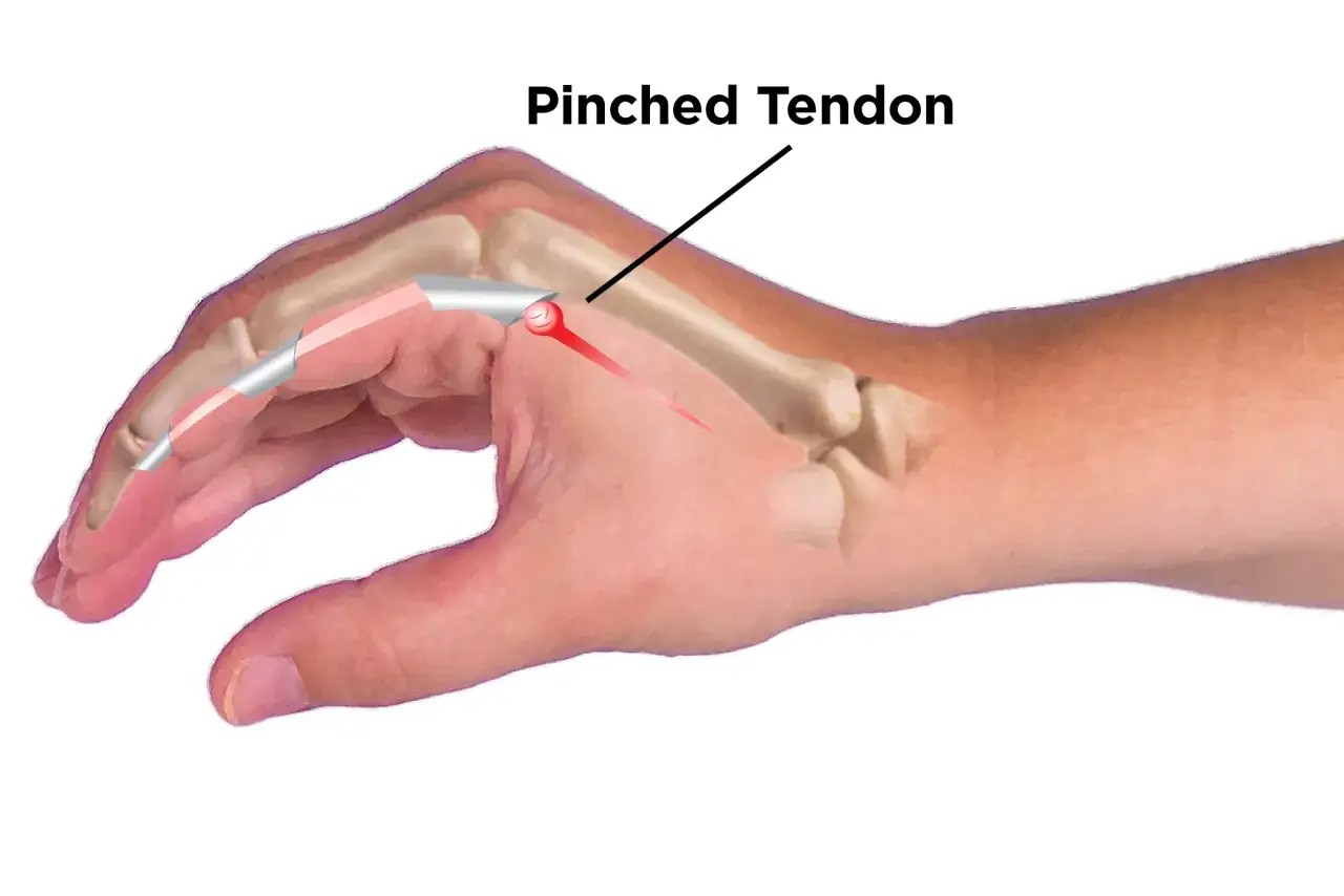 Dito della mano con tendine schiacciato, causa di dolore alle dita delle mani quando stringo.