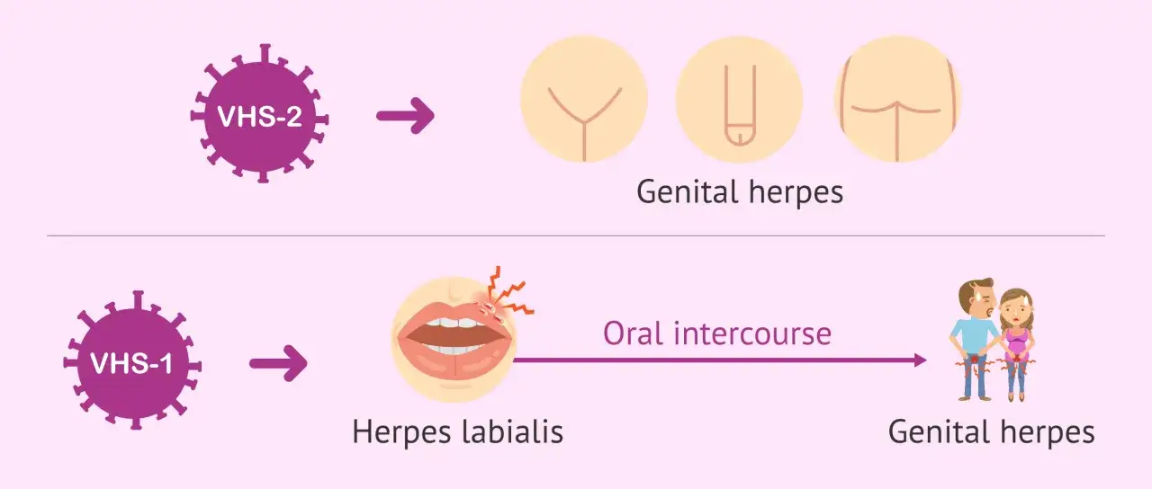 VHS-2 orsakar herpes i underlivet. VHS-1 kan ge muns&aring;r, men &auml;ven herpes i underlivet efter oralsex.