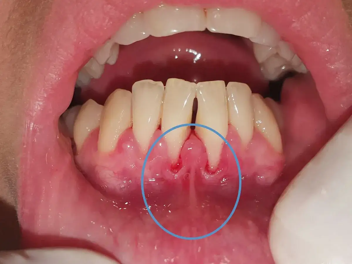 Boca con encías rojas e hinchadas. El frenillo labial inferior inflamado muestra irritación y enrojecimiento.