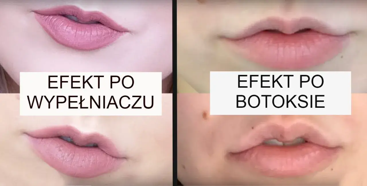 botoks usta lip flip vs kwas hialuronowy powiększanie różnice