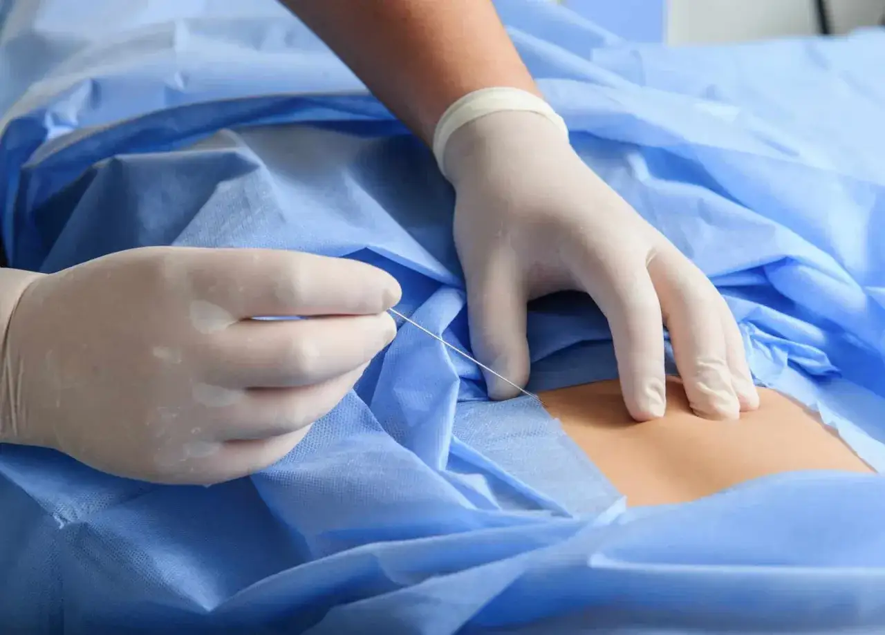 Mains gantées réalisant une infiltration dans le dos, sous champ stérile bleu.