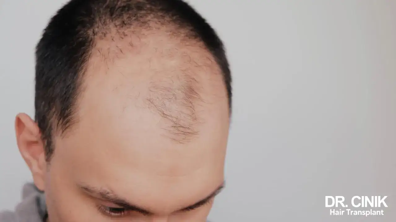 Homme présentant une perte de cheveux sur le devant du crâne, possiblement due à une alopécie frontale fibrosante.