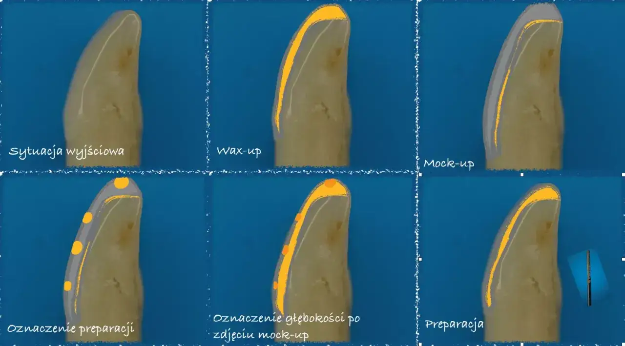 Etapy przygotowania zęba: od sytuacji wyjściowej, przez wax-up i mock-up, po oznaczenie preparacji i ostateczną preparację pod licówki.