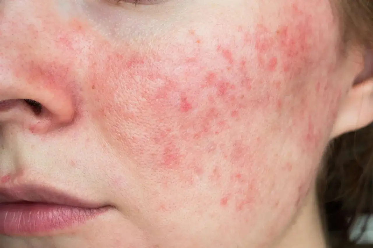 Närbild på en persons ansikte med rodnad och små blåsor i ansiktet, troligen rosacea.