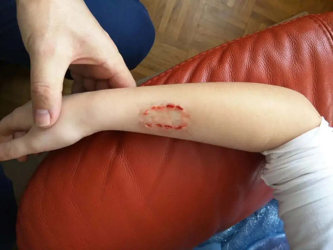 Arm eines Kindes mit einer klaffenden Wunde, die aussieht, als ob ein Hund sie gebissen hat. Ein kleines Loch mit roten Rändern ist sichtbar.