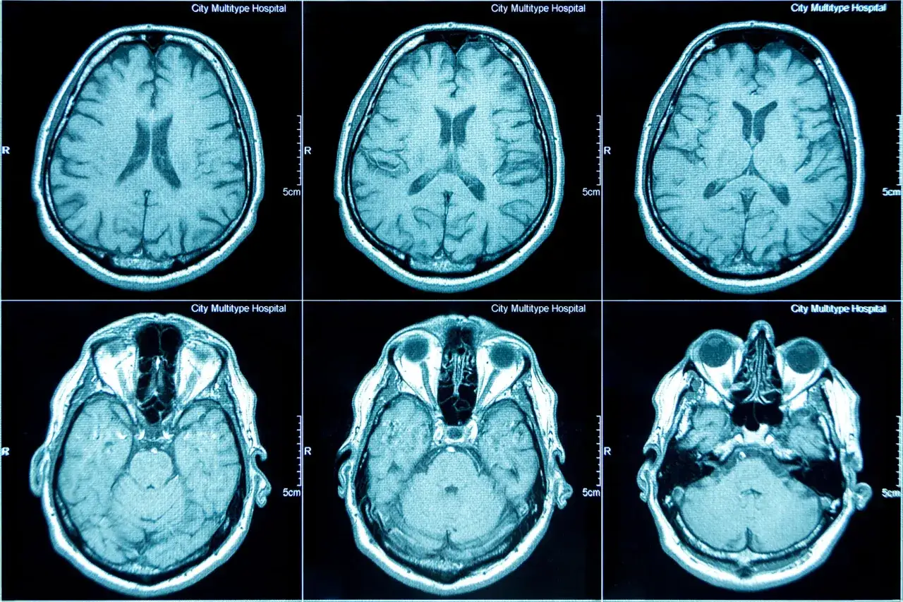 Przekroje mózgu na rezonansie magnetycznym. Choć MRI głowy nie wykryje bezpośrednio chorób psychicznych, może ujawnić zmiany strukturalne.