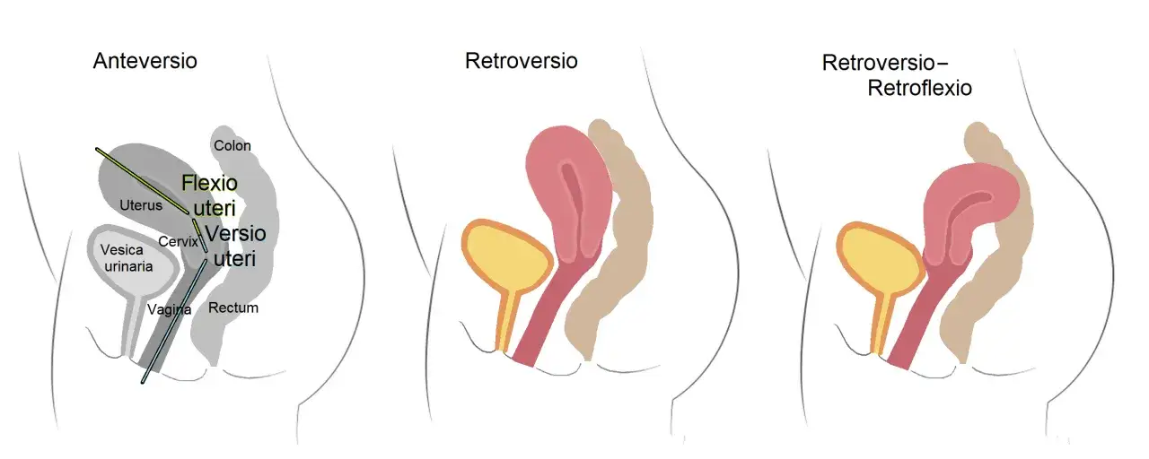 Ilustracje pokazują różne położenia macicy: anteversio (do przodu), retroversio (do tyłu) i retroflexio (tyłozgięcie macicy).