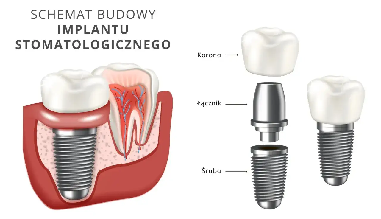 r&oacute;żne rodzaje implant&oacute;w zębowych schemat