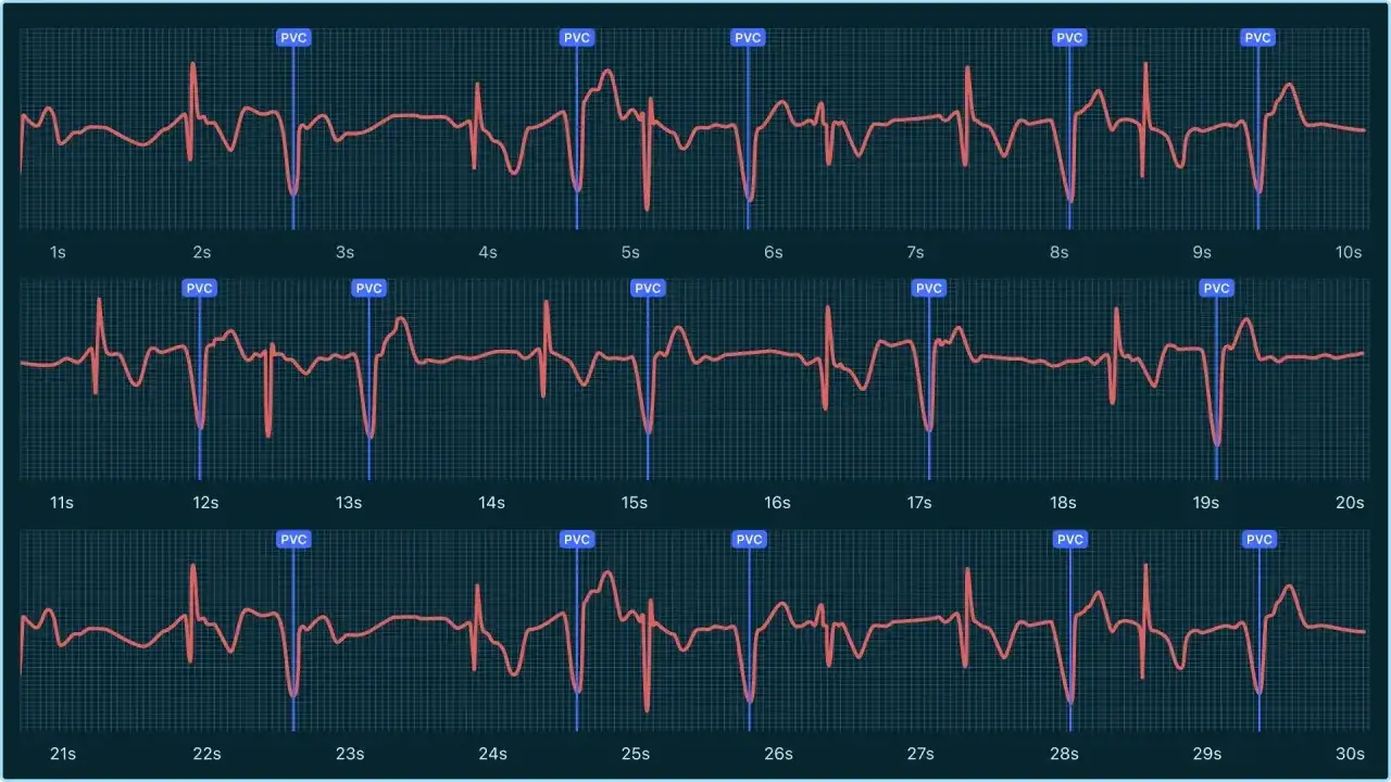 EKG z zaznaczonymi pobudzeniami komorowymi (PVC), które mogą wskazywać na migotanie przedsionków.