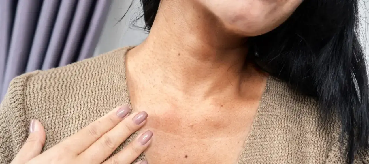 Primer plano del cuello de una mujer con manchas, mostrando la textura de la piel y un su&eacute;ter beige.