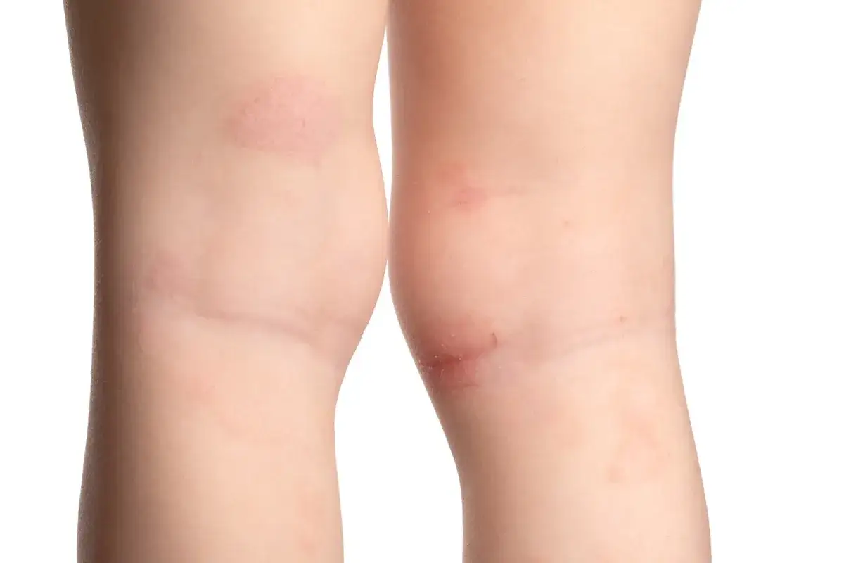 Gambe di bambini con chiazze rosse, simili a funghi, che potrebbero indicare un'irritazione cutanea.