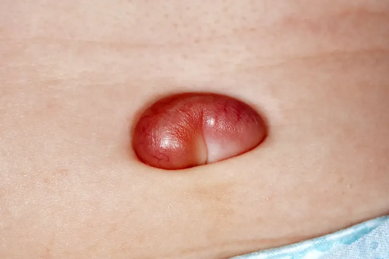 Un rigonfiamento rossastro e lucido, un granuloma ombelicale, sporge dalla pelle chiara.