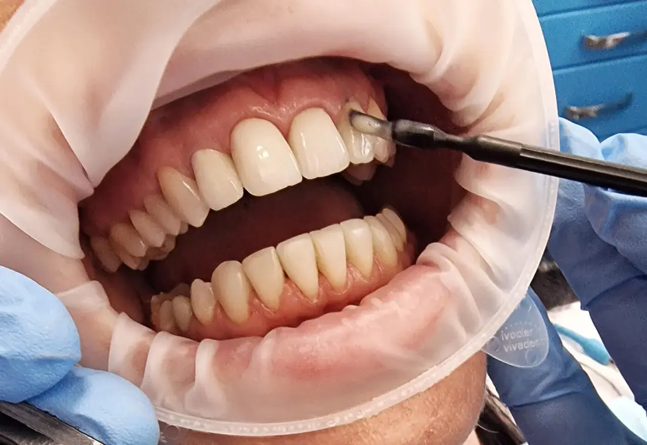 Zabieg lakierowania zębów w gabinecie stomatologicznym. Dentysta aplikuje środek ochronny na zęby.