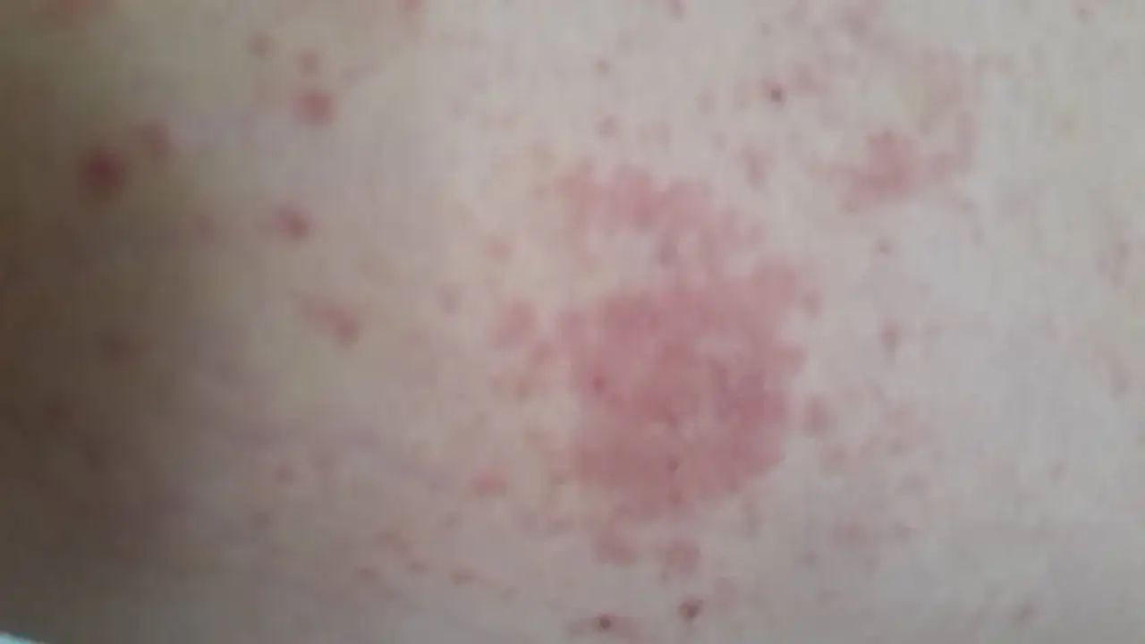 &Eacute;ruption cutan&eacute;e ros&eacute;e sur la peau, possiblement li&eacute;e &agrave; un staphylocoque dor&eacute; combien de temps apr&egrave;s op&eacute;ration.