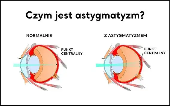 oko astygmatyzm rogówka kształt
