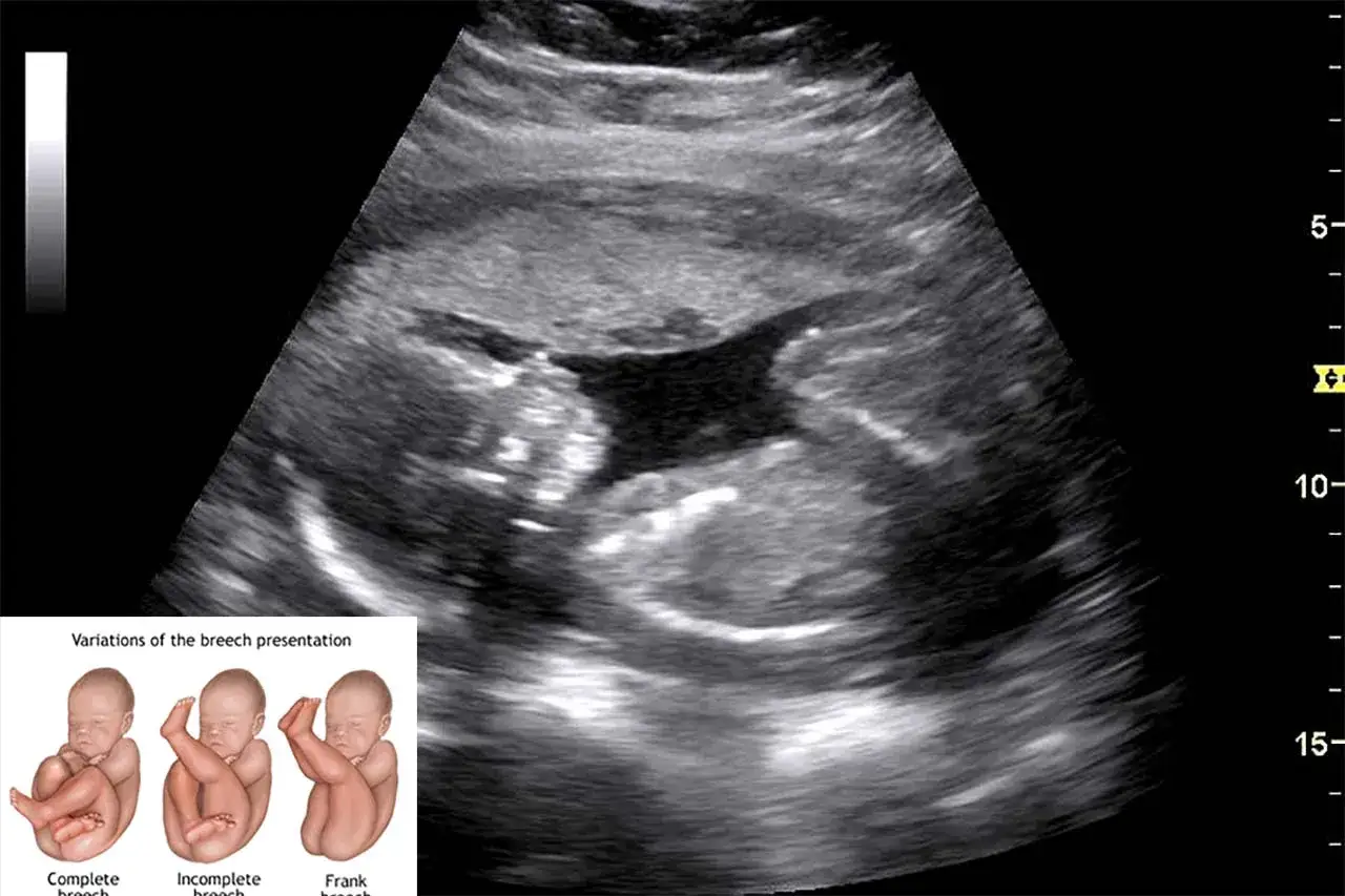 Ecografia fetale mostra il bambino in causa posizione podalica. L'immagine illustra le variazioni della presentazione podalica.