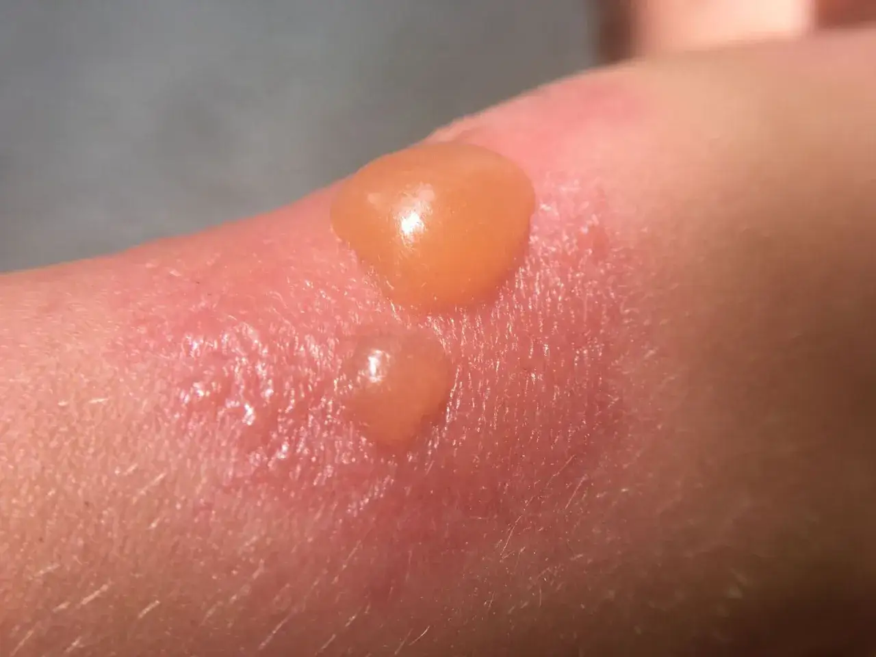 Une petite cloque d'eau sur la peau, signe d'une brûlure due au soleil. La peau est rouge et irritée autour de la cloque.