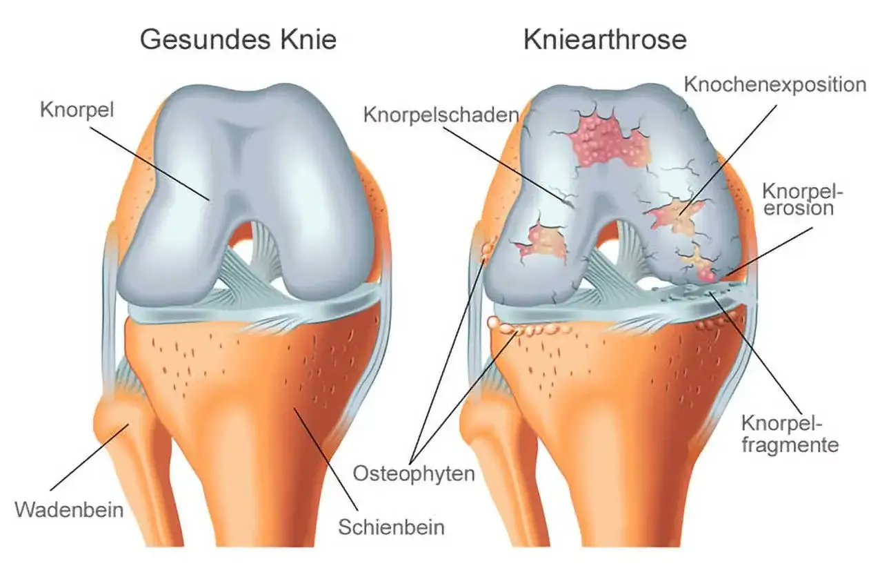 Vergleich gesunder und arthrosegeschädigter Knie. Die Arthrose zeigt Knorpelschäden, Knochenexposition und Osteophyten. Eine Arthrose Spritze kann hier Linderung verschaffen.