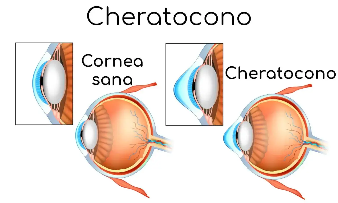 Confronto tra cornea sana e cheratocono: la vista di un occhio con cheratocono mostra una cornea deformata e assottigliata.