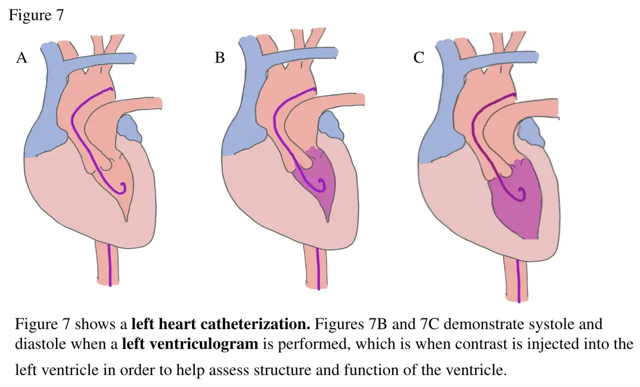 Sch&eacute;ma d'un cath&eacute;t&eacute;risme cardiaque gauche. Le ventriculogramme gauche injecte du produit de contraste pour &eacute;valuer la structure et la fonction du c&oelig;ur.