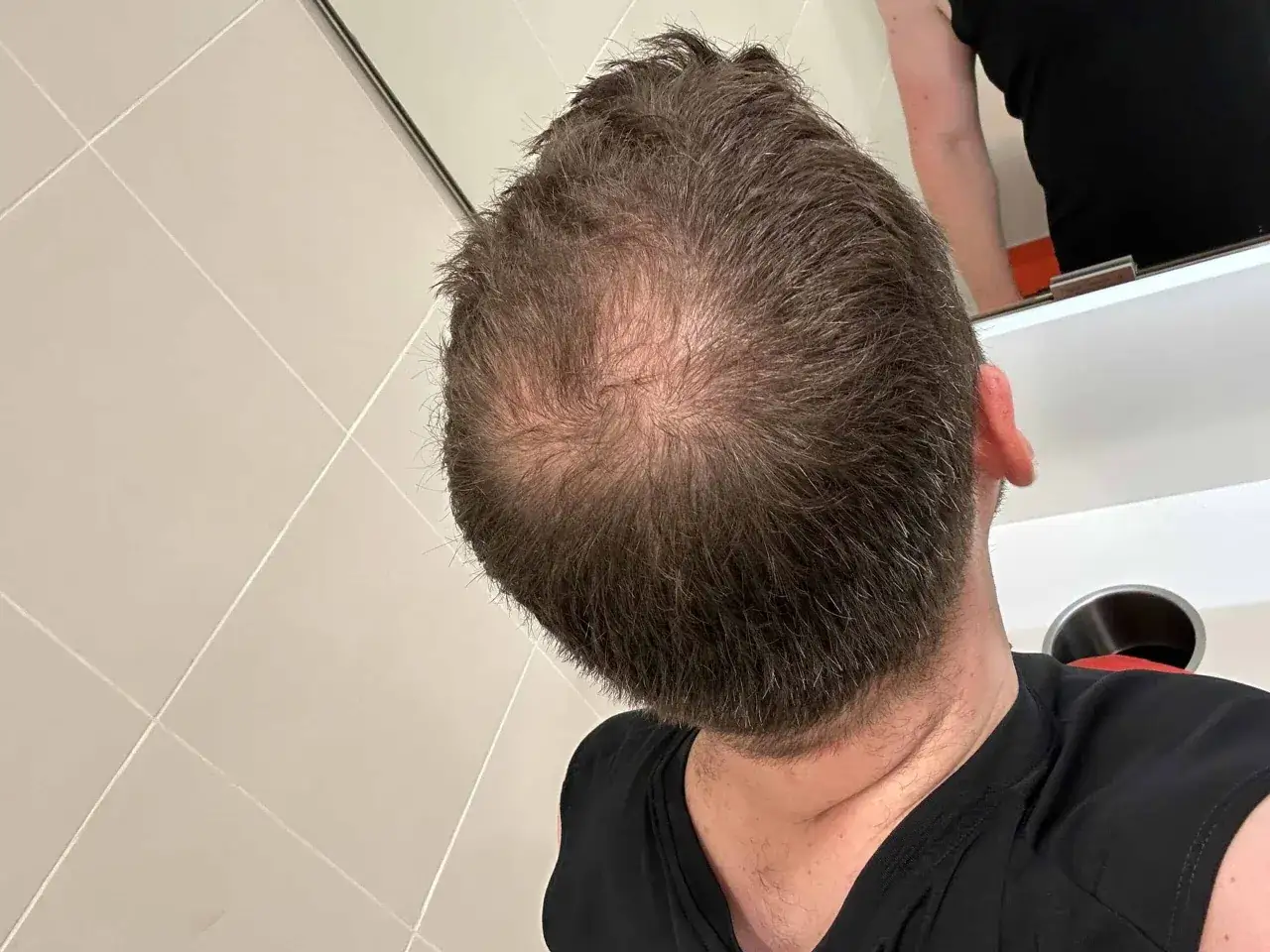 Vista superior de la cabeza de un hombre con un remolino de pelo visible en la coronilla, reflejado en un espejo.