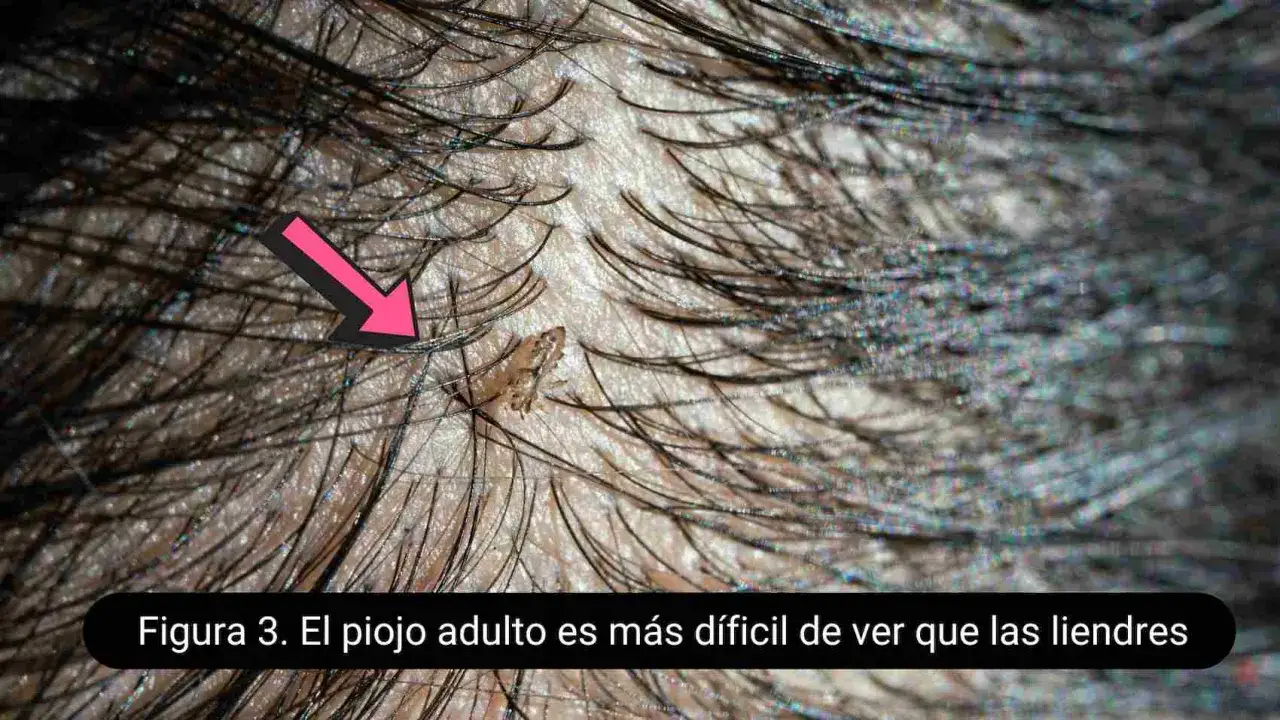 Un piojo adulto, pequeño y de color claro, se aferra a un cabello oscuro. La imagen muestra cómo es un piojo.