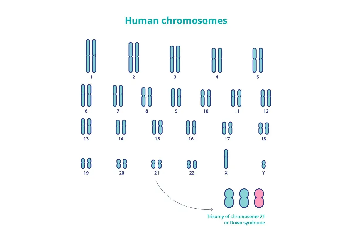 Cariotipo humano que muestra la trisomía del cromosoma 21, causa de la enfermedad de Down.