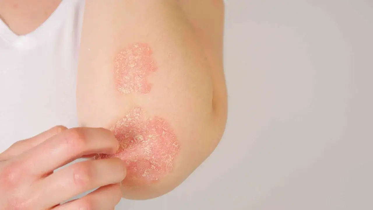 Un coude pr&eacute;sente des plaques rouges et squameuses, signe d'ecz&eacute;ma. Une main s'approche pour gratter.