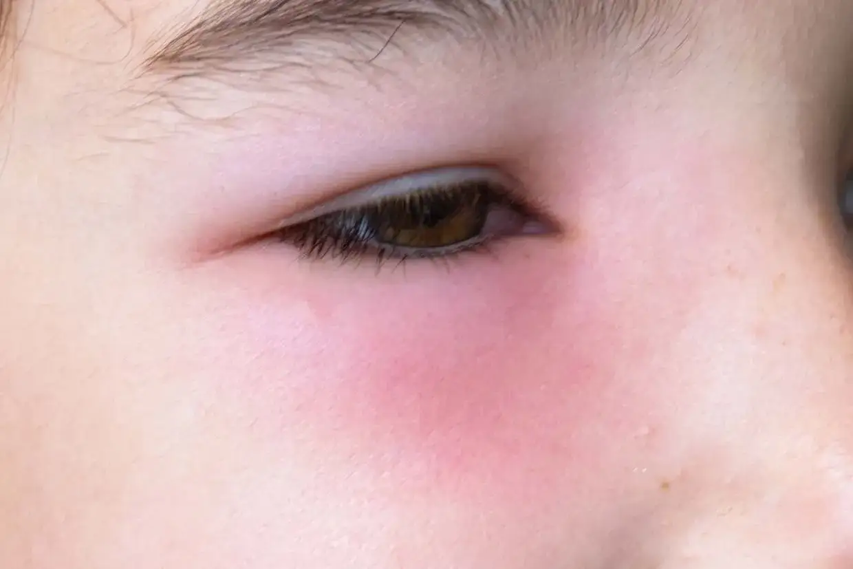 &OElig;il rougi et enfl&eacute;, signe d'une allergie au mascara. La peau autour de l'&oelig;il est irrit&eacute;e et rouge.