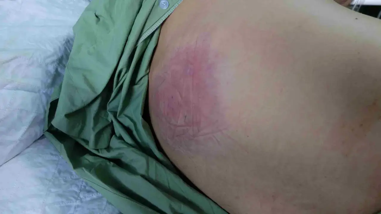 Arrossamento e irritazione sul gluteo, possibili piaghe decubito sedere. La pelle appare segnata da pieghe.