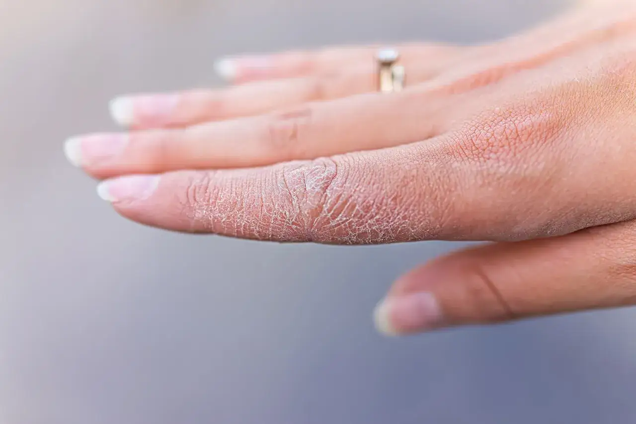Primer plano de una mano con piel agrietada y escamosa, indicando manos secas. Un anillo de compromiso adorna el dedo anular.