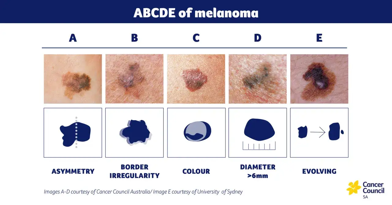 ABCDE znamiona: asymetria, nierówne brzegi, różnorodność kolorów, średnica >6mm, ewolucja.