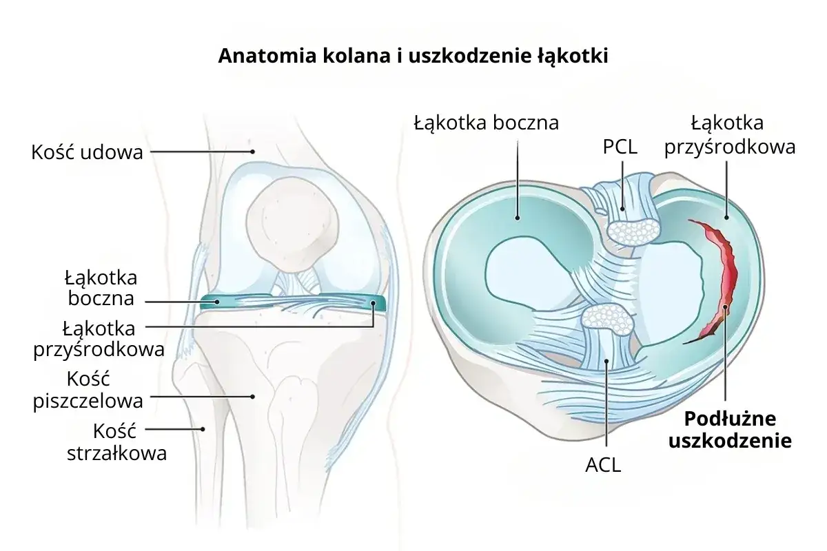 Anatomia kolana z widoczną łąkotką boczną i podłużnym uszkodzeniem łąkotki przyśrodkowej.