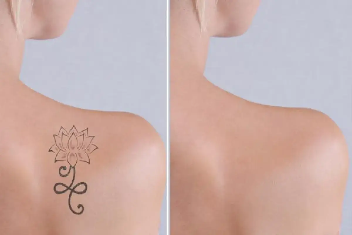 Pelle dopo rimozione tatuaggio: confronto tra spalla con fiore e spalla senza.