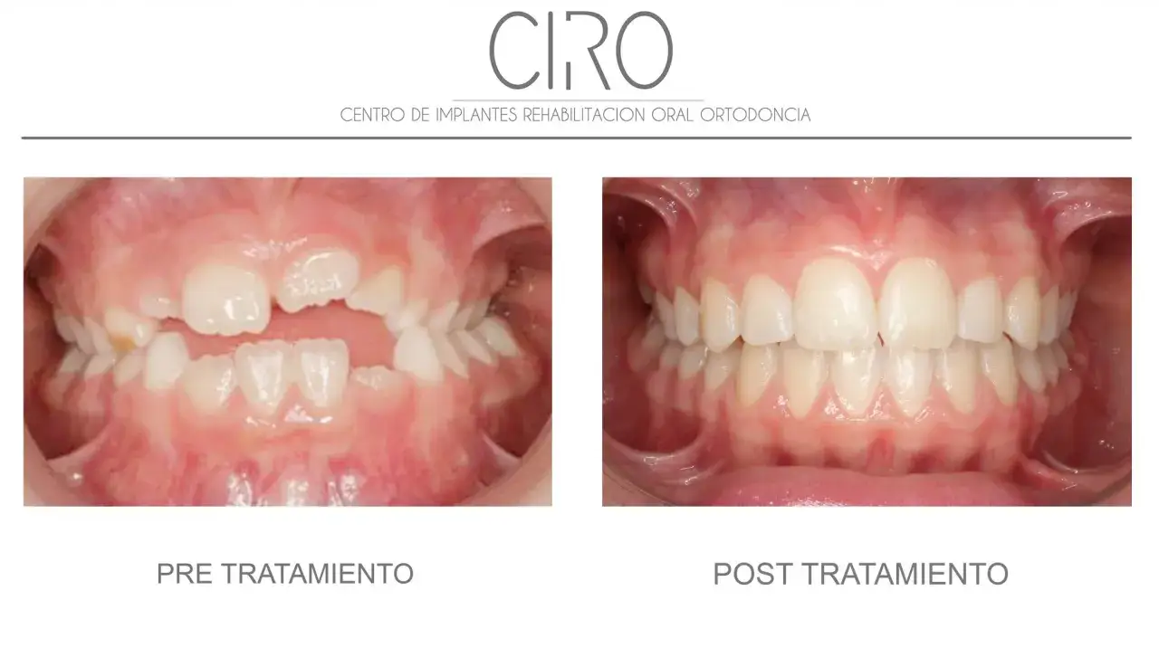 Dientes apiñados antes y después del tratamiento con **invisalign aligners**. Sonrisas alineadas y saludables.