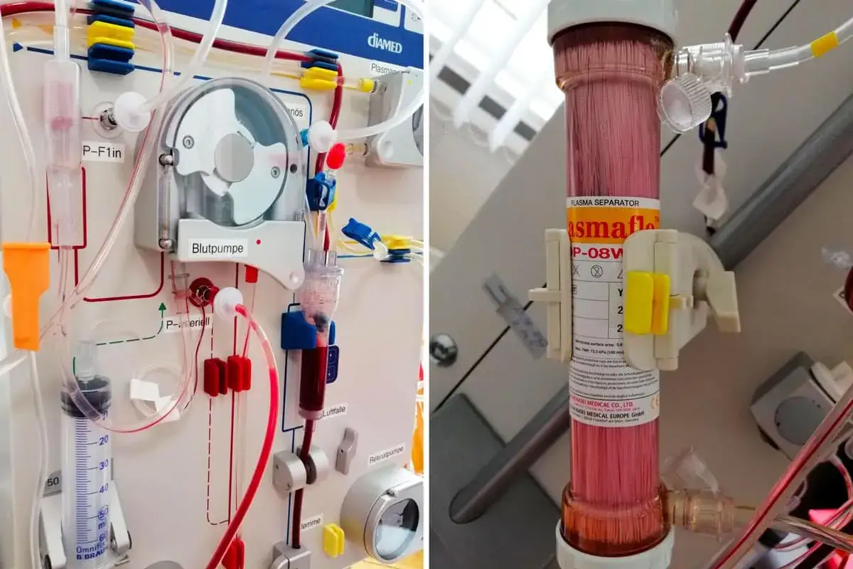 Nahaufnahme eines medizinischen Geräts, das den **Leukapherese Ablauf** zeigt. Blutpumpe und Plasma Separator sind sichtbar.