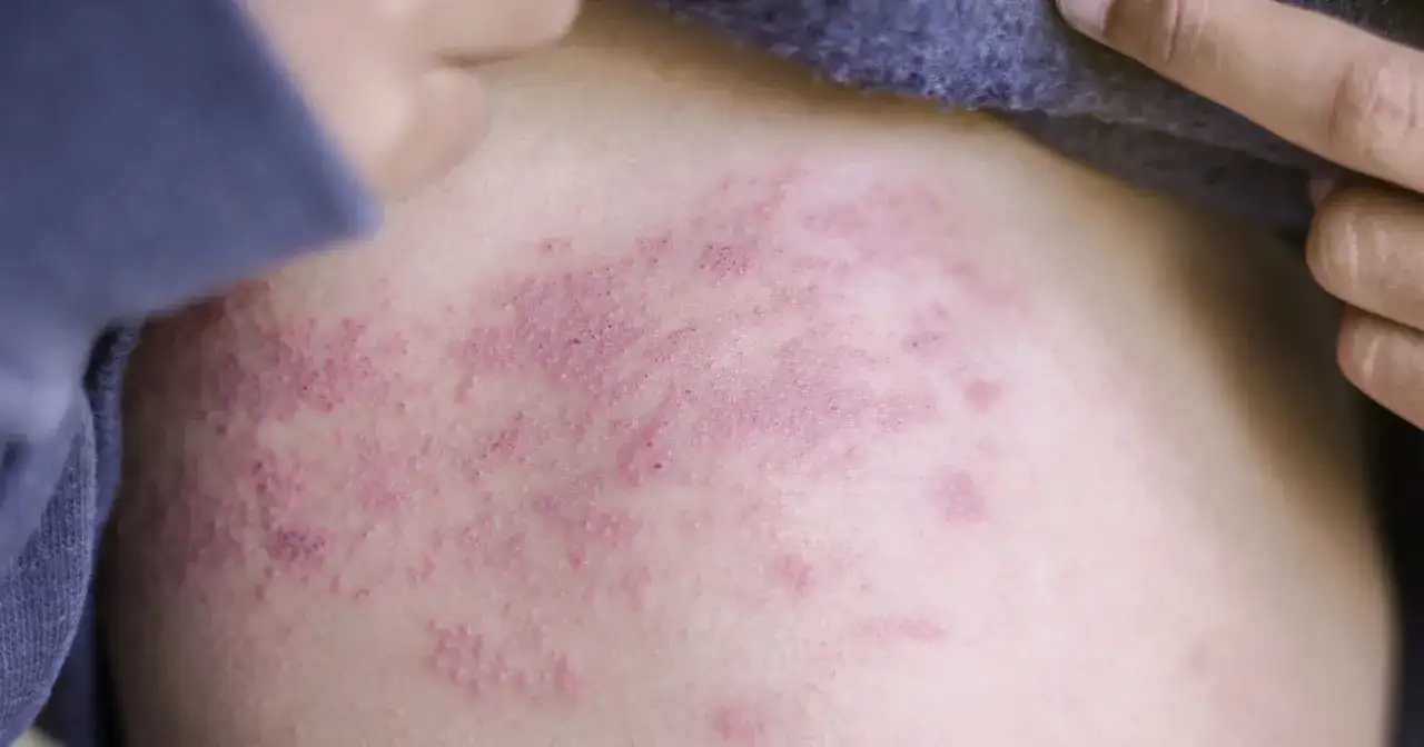 Czerwone plamy na klatce piersiowej u mężczyzn, widoczne pod fragmentem ubrania.