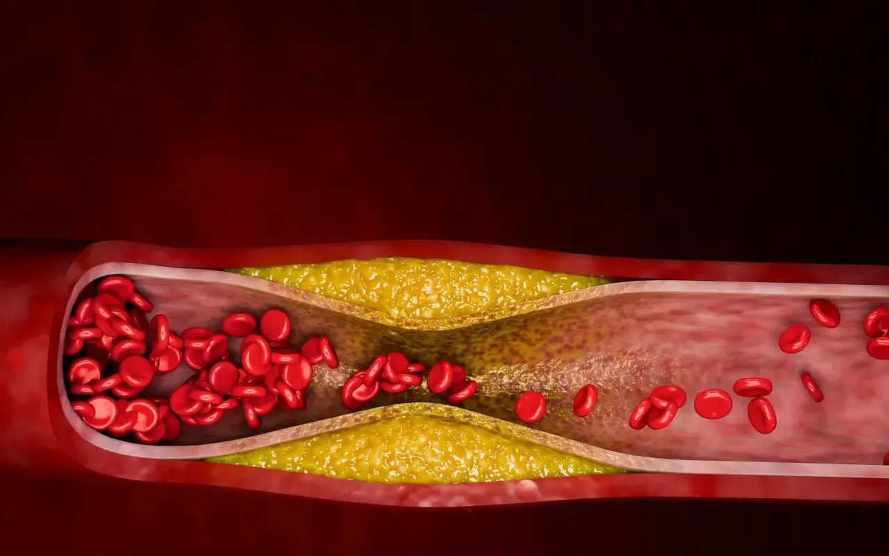 Zwężone naczynie krwionośne z blaszką miażdżycową i czerwonymi krwinkami. Badanie lipoprotein pomaga ocenić ryzyko chorób serca.
