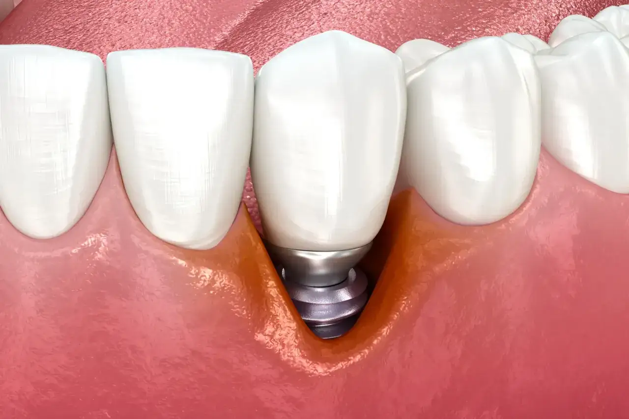 Widok zbliżenia na implant zęba, który jest osadzony w kości szczęki. Widać metalową śrubę implantu i białą koronę zęba.