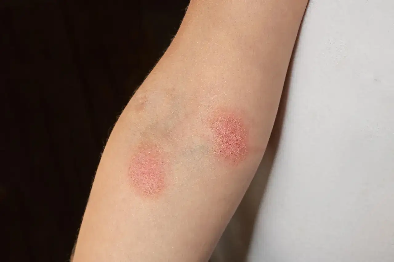 Plaques rouges et squameuses sur le bras, symptômes de la dermatite atopique.