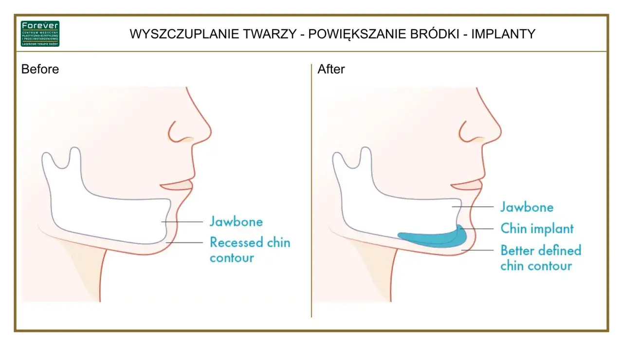Przed i po zabiegu genioplastyki. Ilustracja pokazuje implant brody, który poprawia kontur żuchwy.