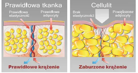 cellulit wiotka skóra tkanka tłuszczowa obrzęki