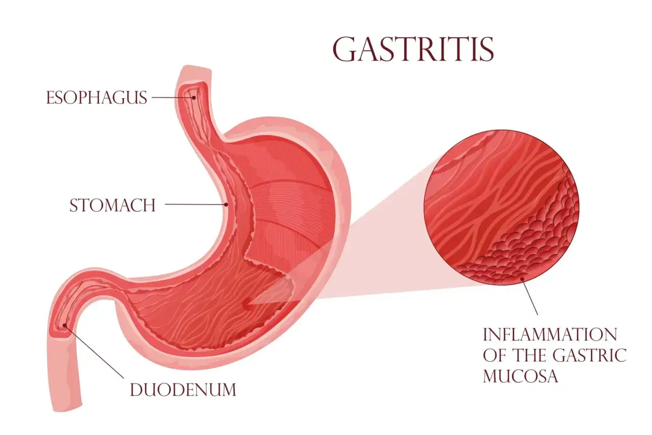 Illustrazione anatomica dello stomaco, esofago e duodeno. Un ingrandimento mostra l'infiammazione della mucosa gastrica, tipica della gastrite cronica.