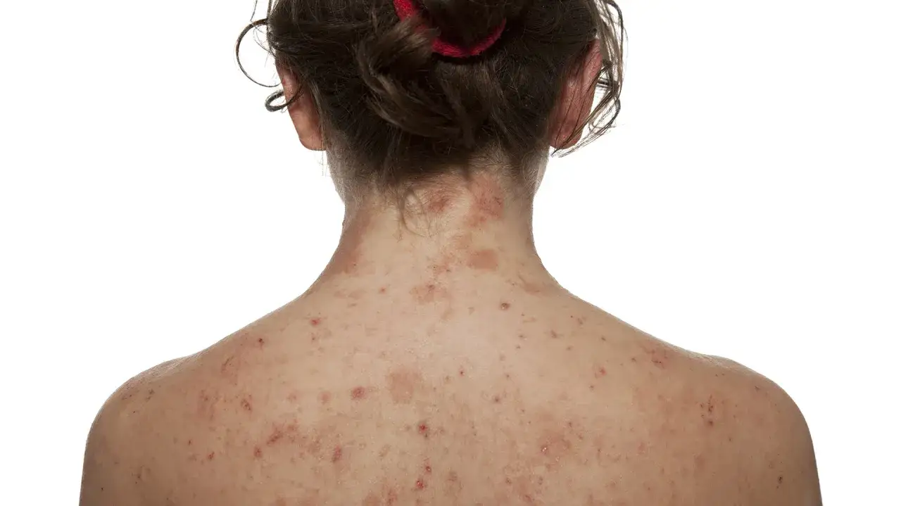 Espalda y cuello con manchas rojas y granitos, indicando posibles manchas en la espalda por estr&eacute;s.