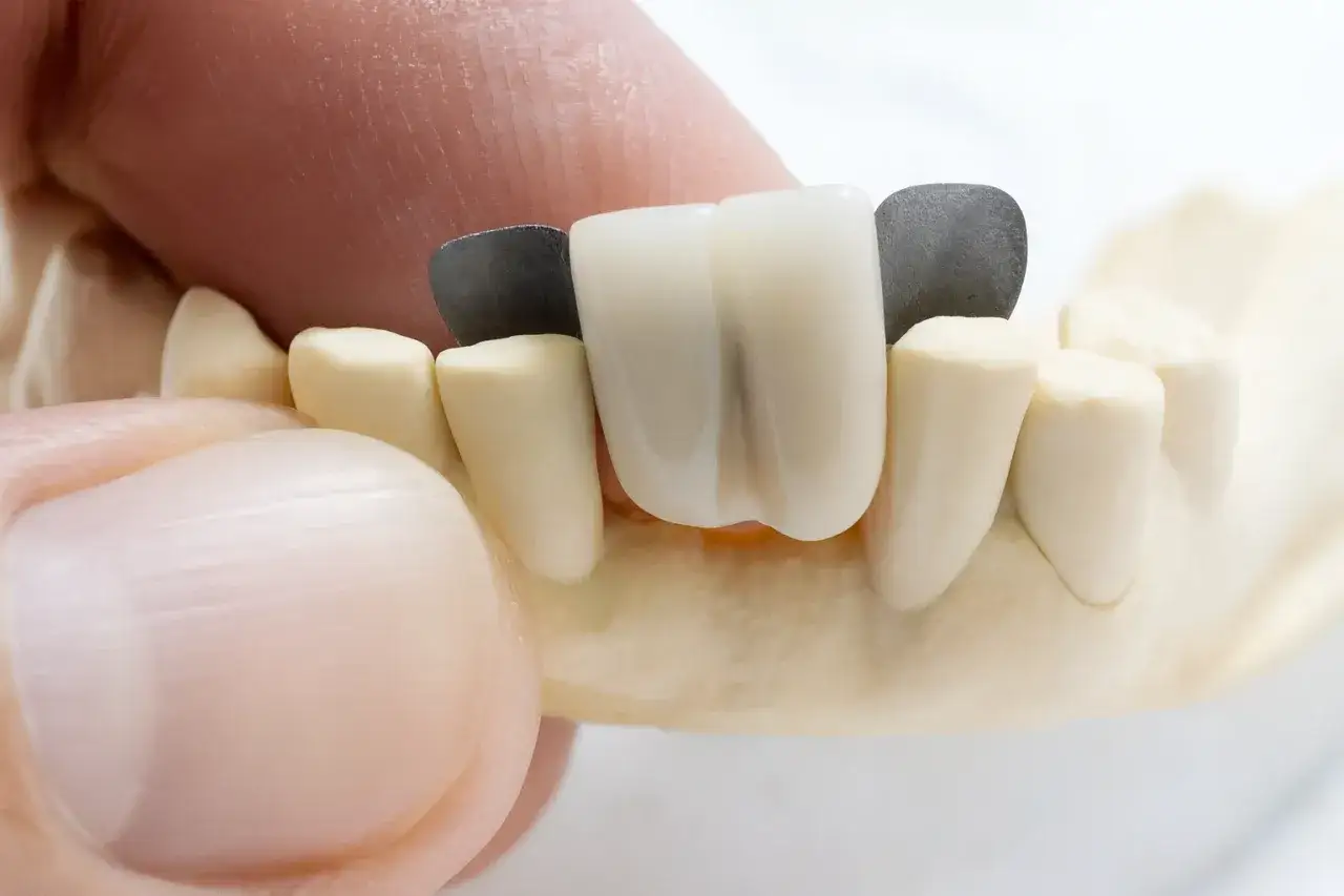 Denti in ceramica e metallo su un modello, un dente centrale in ceramica bianca si stacca leggermente.