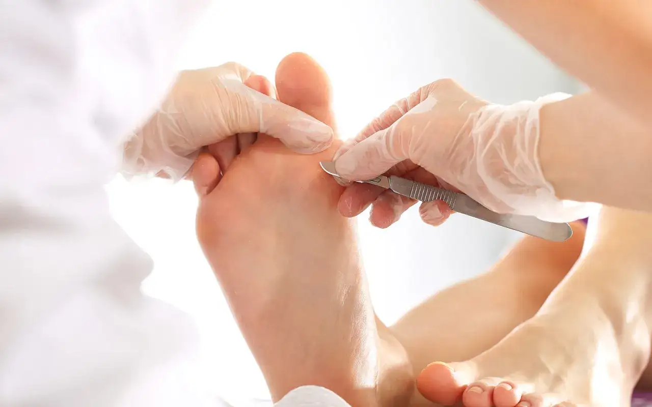 Un podologue utilise un scalpel pour traiter un pied. Le tarif conventionné podologue assure des soins abordables.