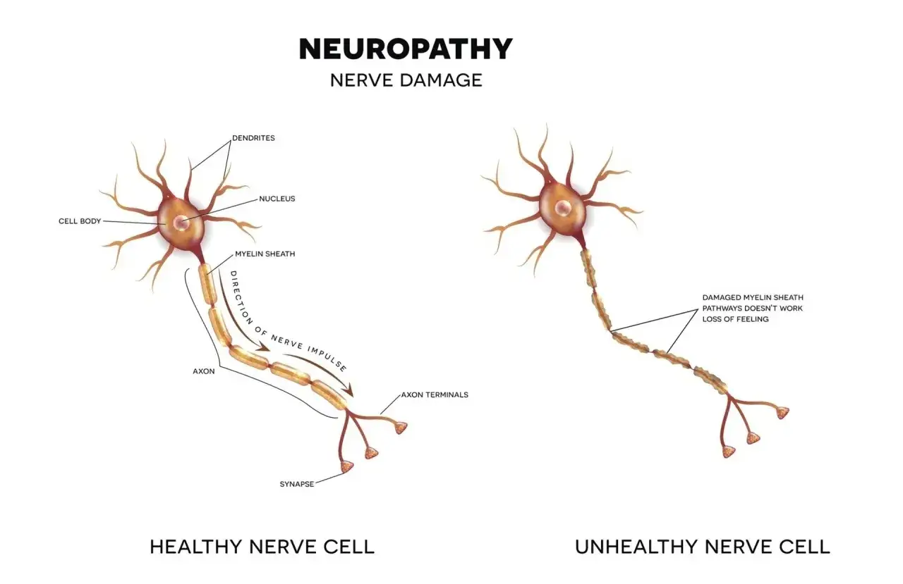 Ilustracja porównuje zdrowy i uszkodzony neuron, wyjaśniając, czym jest neuropatia – uszkodzenie nerwów prowadzące do utraty czucia.