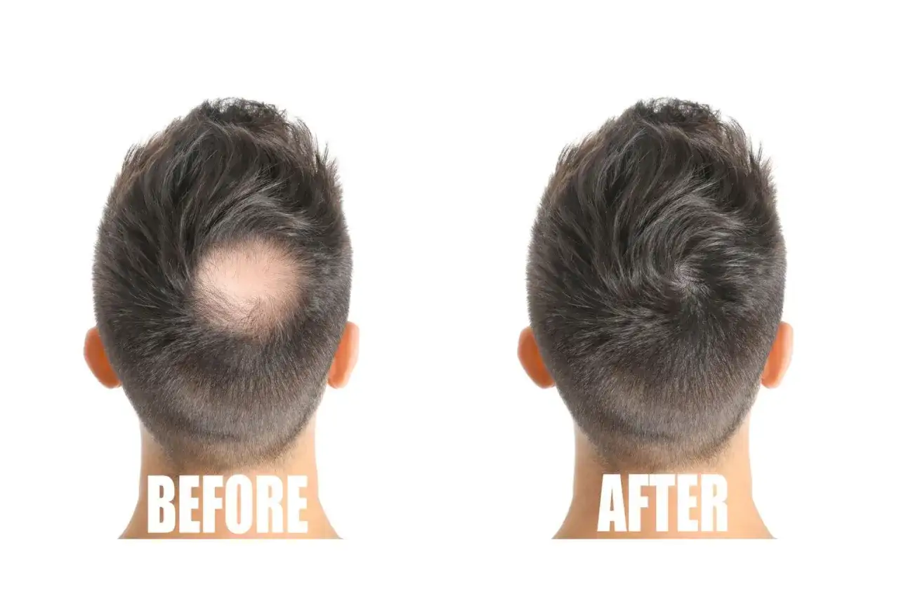 Före och efter bilder som visar effekten av microneedling i hårbotten för att stimulera hårväxt.