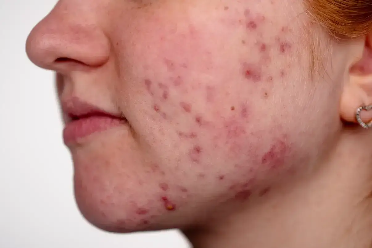 Primo piano del viso di una persona con acne, arrossamenti e imperfezioni. La pelle mostra segni di stress e infiammazione.