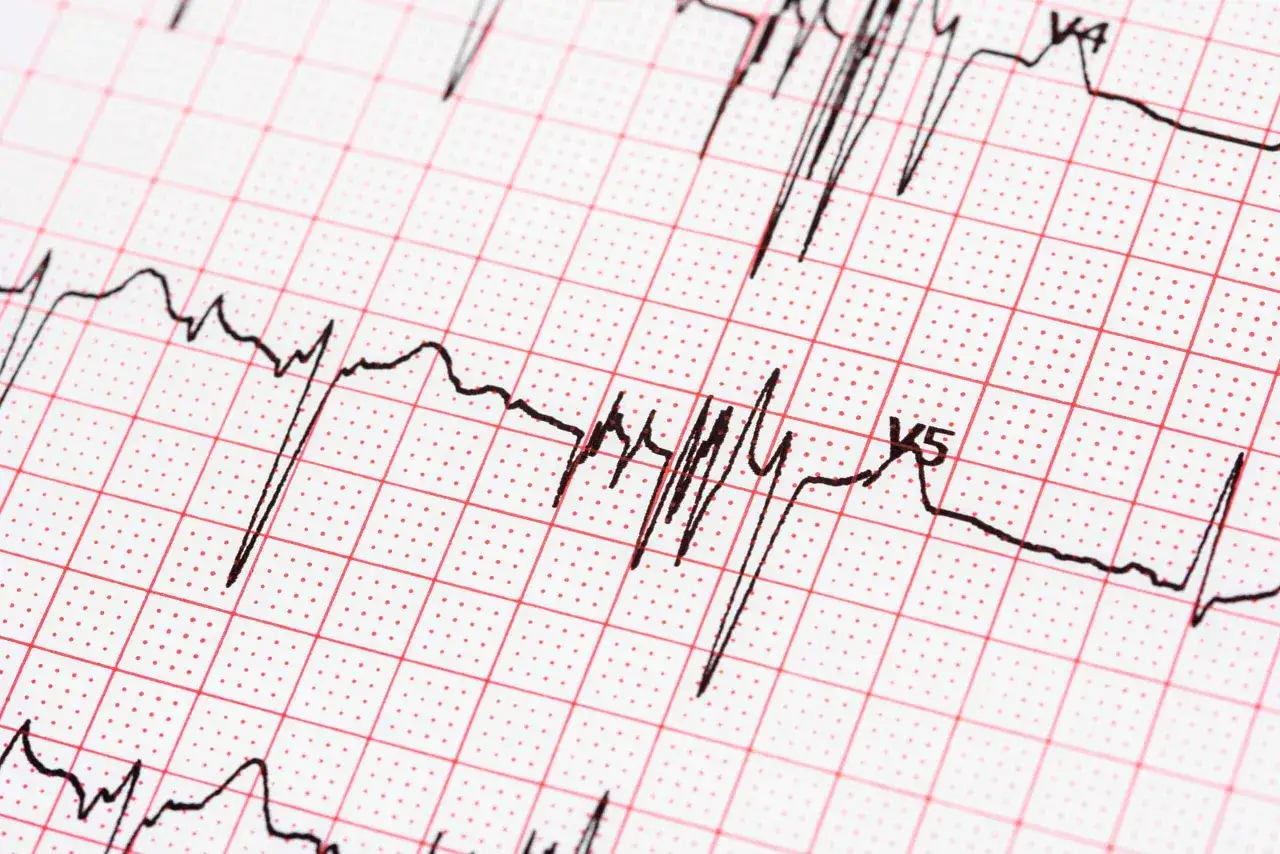 Zapis EKG z migotaniem przedsionków. Długość życia zależy od wielu czynników, ale nowoczesna medycyna daje nadzieję.